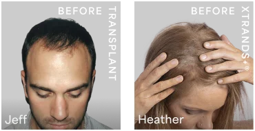 Before results — Jeff (surgery) and Heather (Xtrands+)
