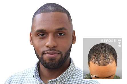 SMP scalp pigmentation