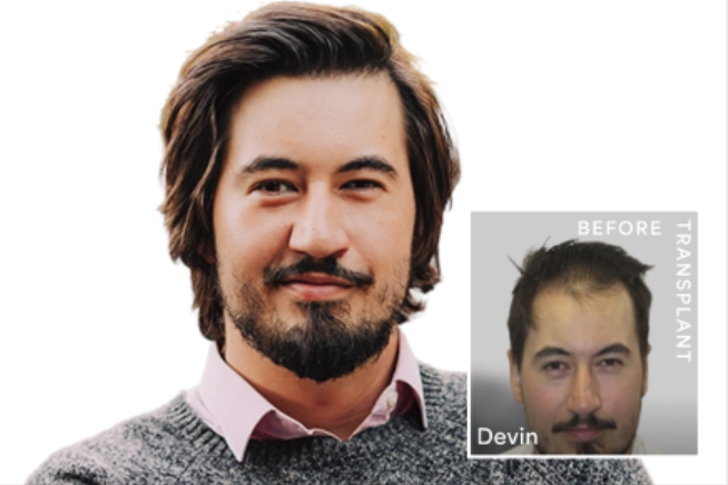Hair transplant results