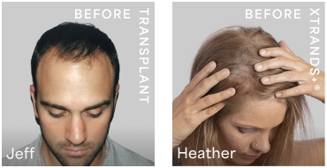 Before results — Jeff (surgery) and Heather (Xtrands+)