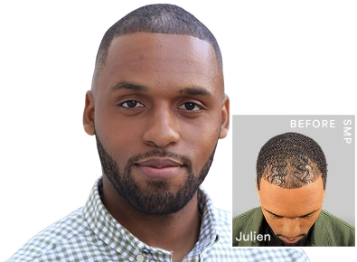 SMP scalp pigmentation